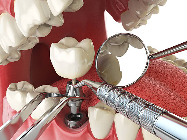 Best Emergency Dental Extractions in Ladue, MO